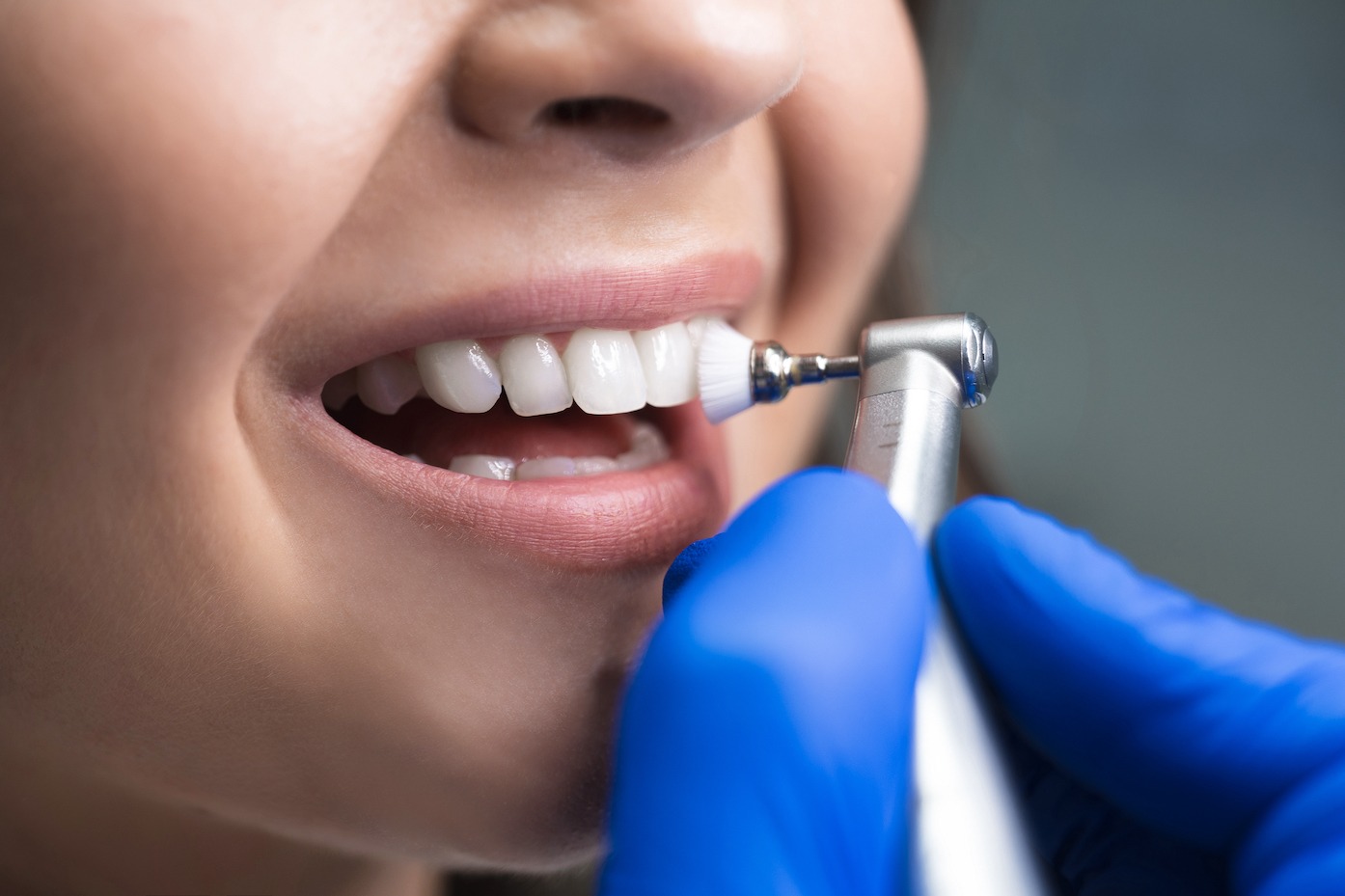 Professionelle Zahnreinigung - Vorsorge und Ästhetik