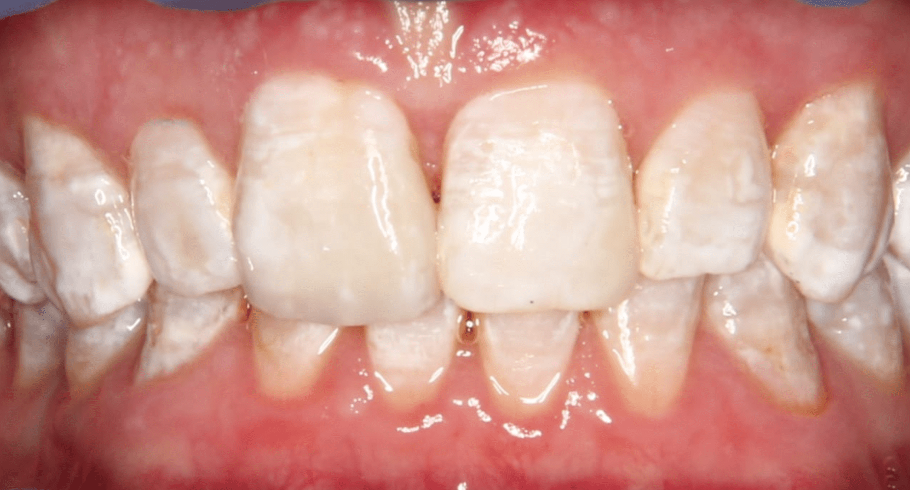Nachher Ansicht: Zahnkorrektur mit Komposit-Mehrschichttechnik in der Zahnfront