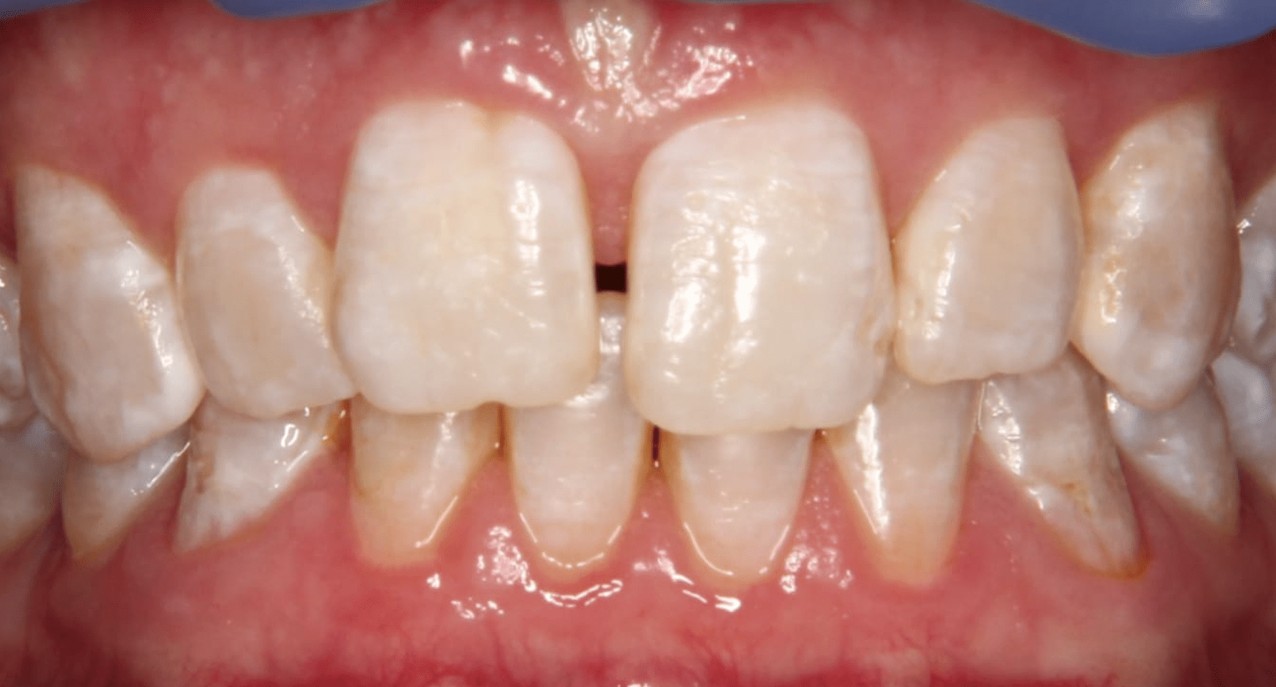 Vorher Ansicht: Zahnkorrektur mit Komposit-Mehrschichttechnik in der Zahnfront